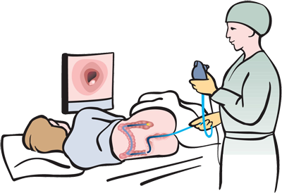 Колоноскопия